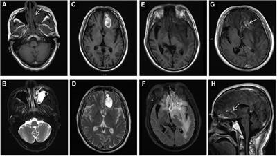 Case Report: Radiation necrosis mimicking tumor progression in a patient with extranodal natural killer/T-cell lymphoma
